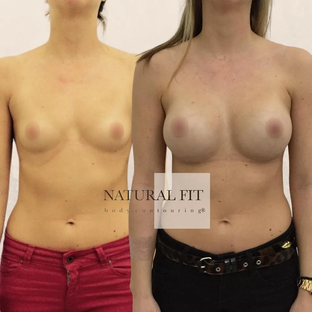 Resultado aumento de pecho Verónica, mamá joven, Barcelona - Dr. Martín Gastón